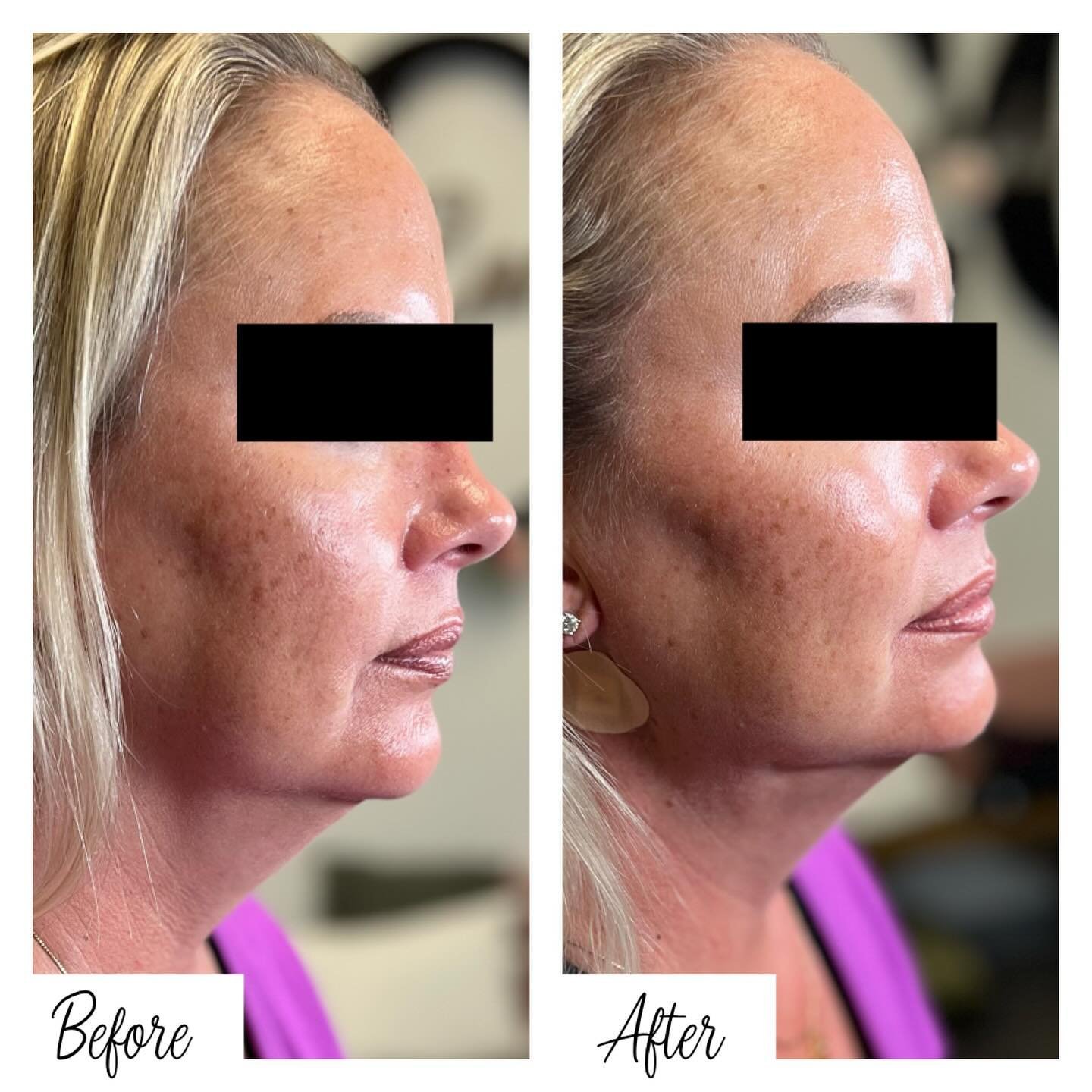 pdo thread lift vs facelift