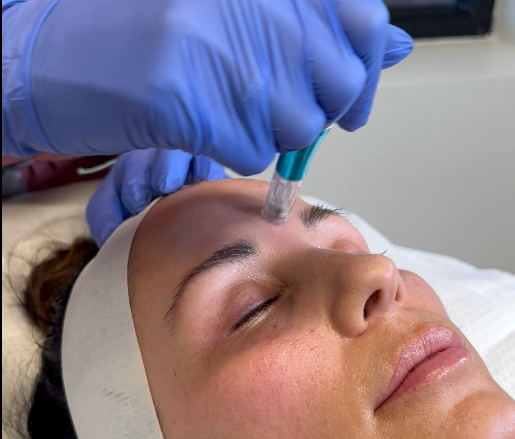 MicroNeedling Procedure @Cyrus Cosmetics