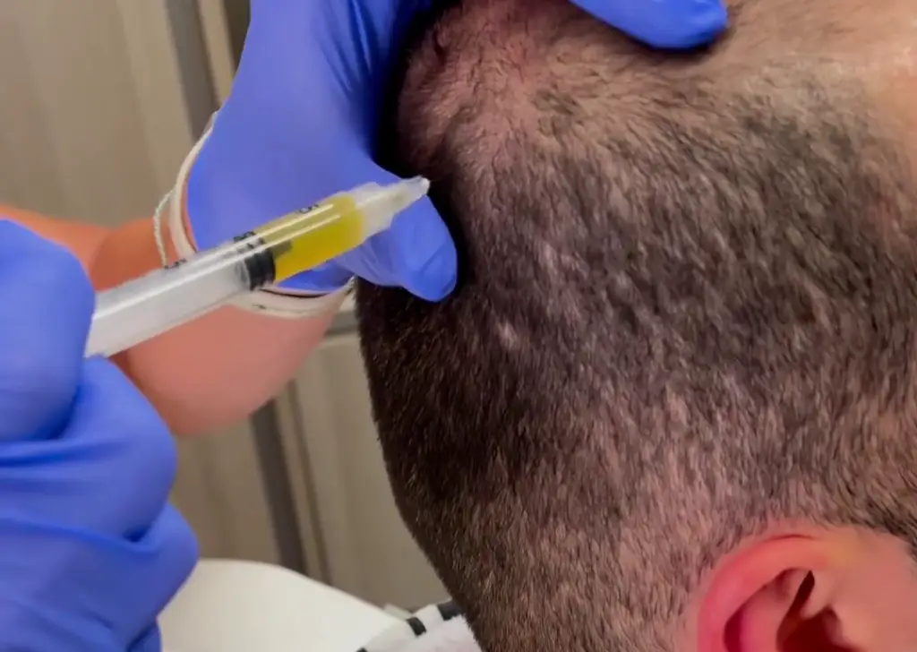 Hair Restoration at Cyrus Cosmetics