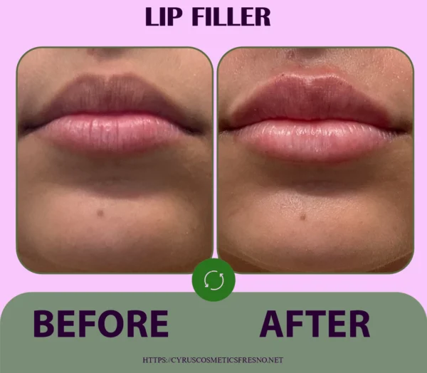 Lip filler Special