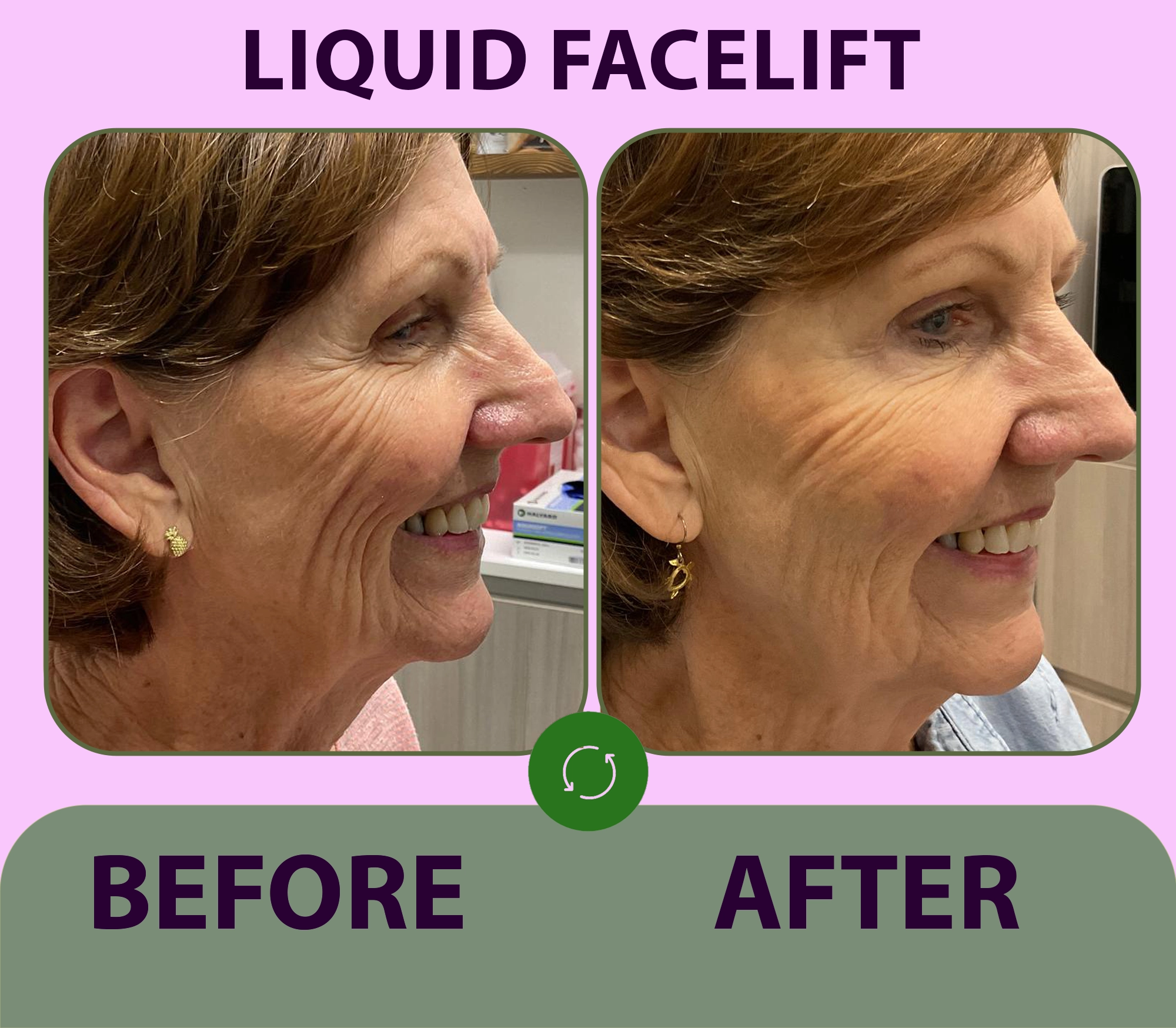 Liquid Facelift