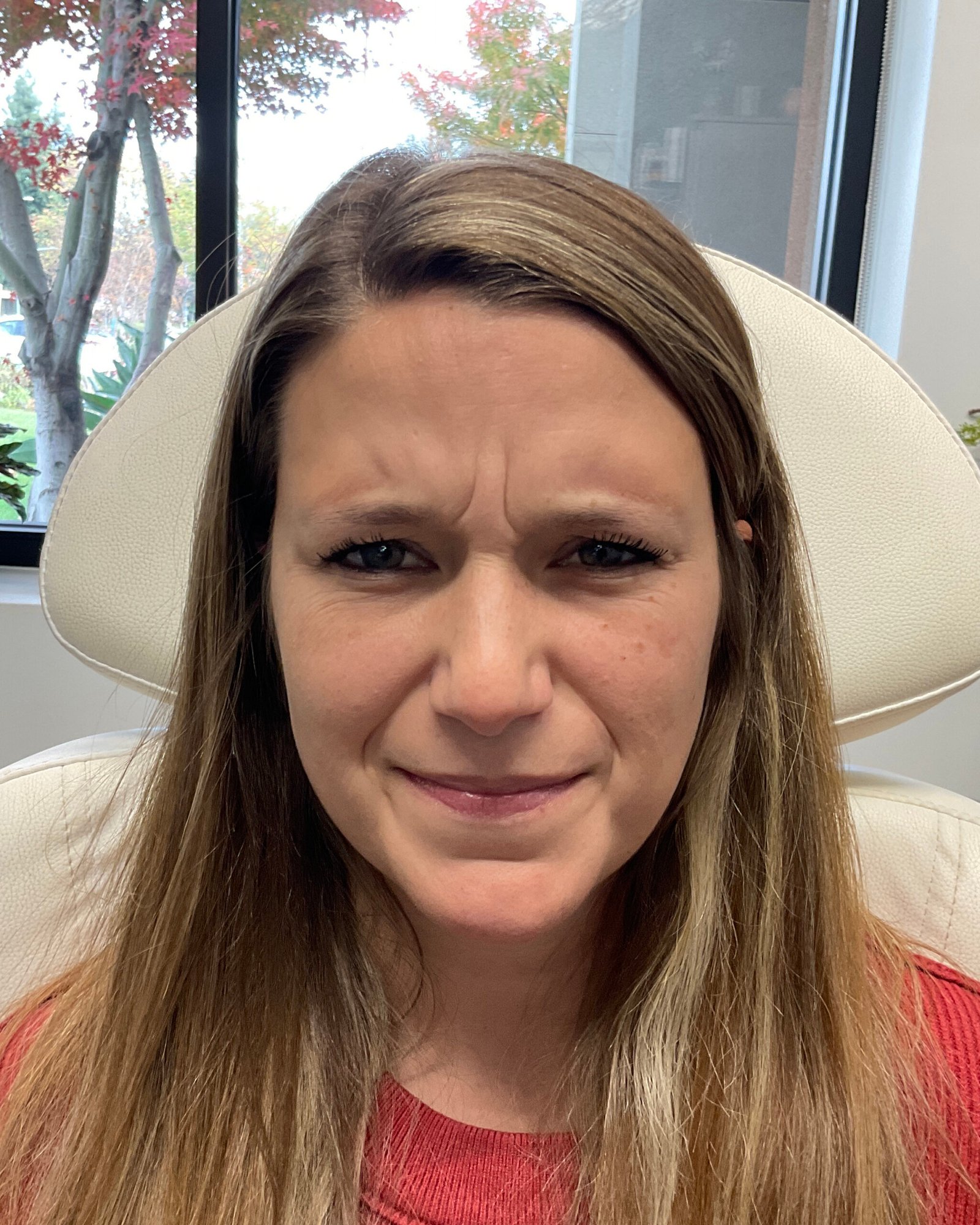 Before Jeuveau treatment - visible forehead lines and frown lines