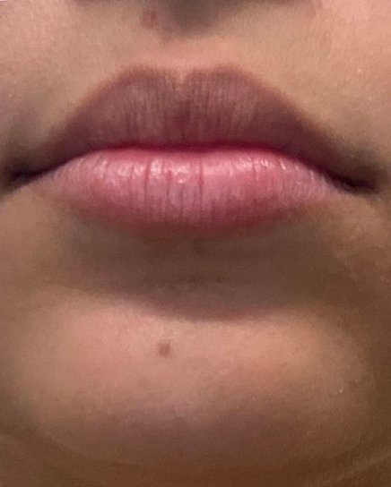Before Lip Fillers treatment - natural lip shape with minimal volume