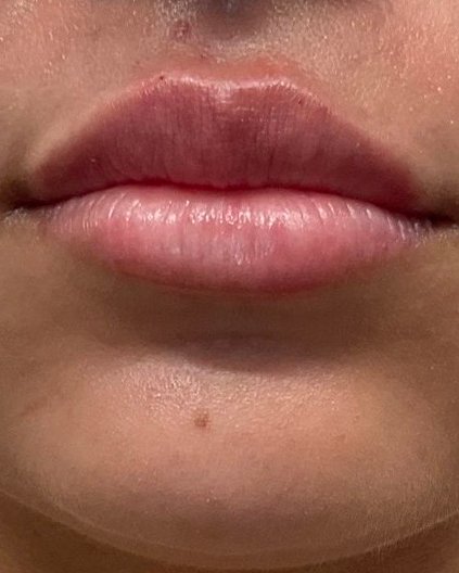 After Lip Fillers treatment - fuller, symmetrical, and naturally enhanced lips