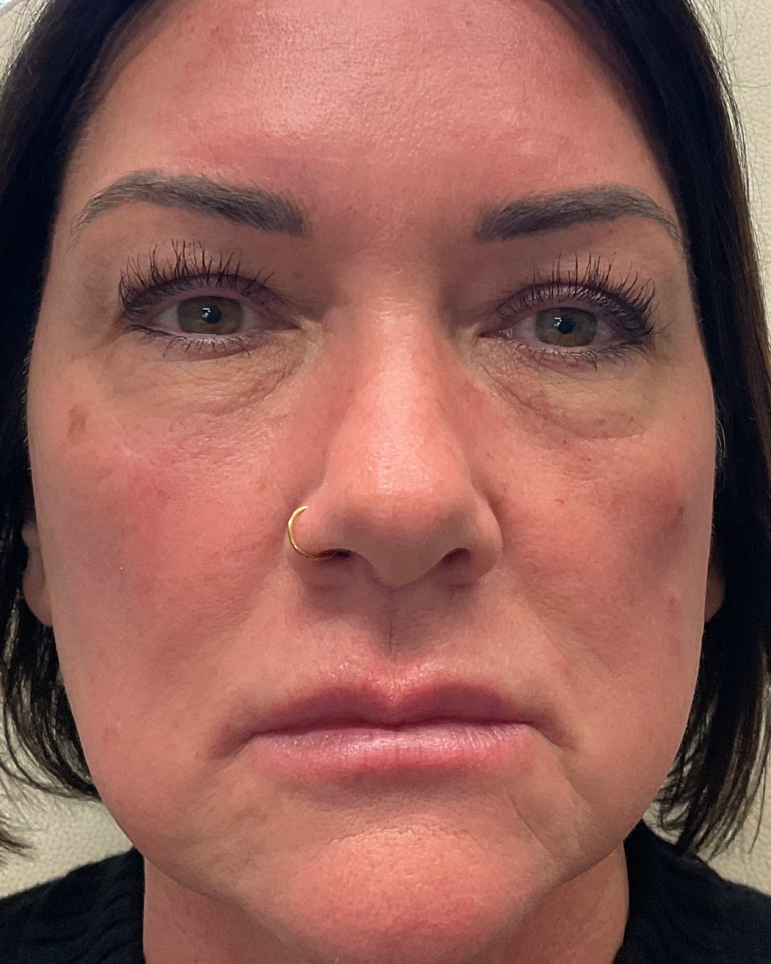 Before Liquid Facelift treatment - side profile with less volume and definition