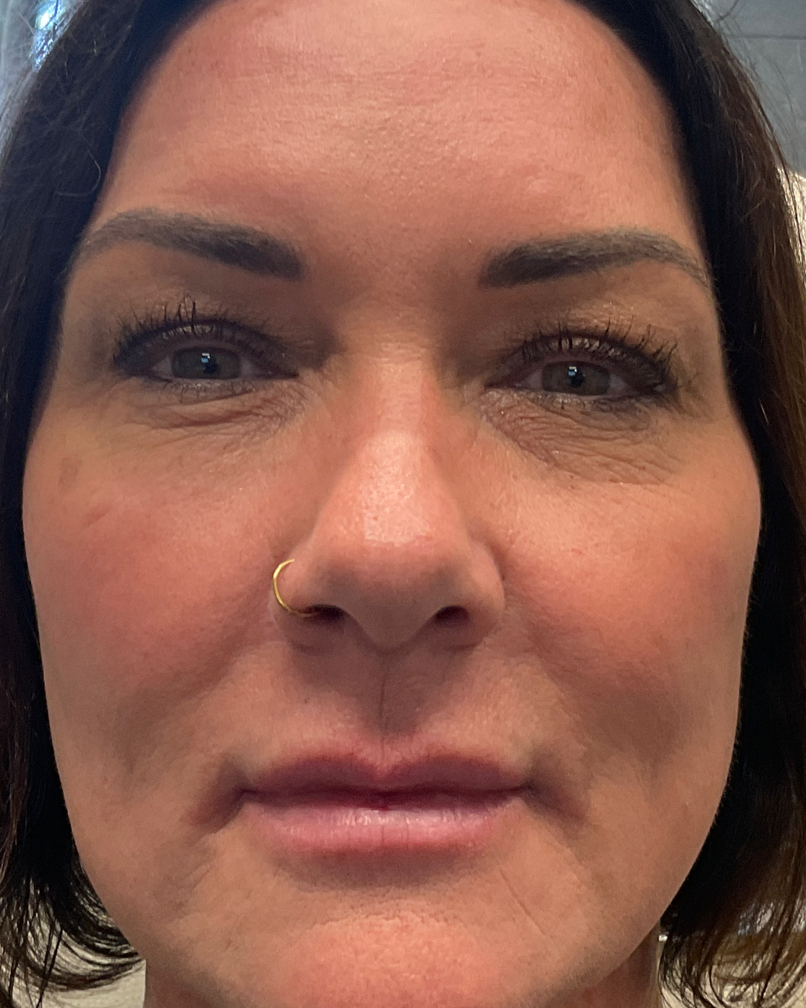 After Liquid Facelift treatment - enhanced facial volume, symmetry, and youthful appearance