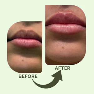 Dermal Fillers