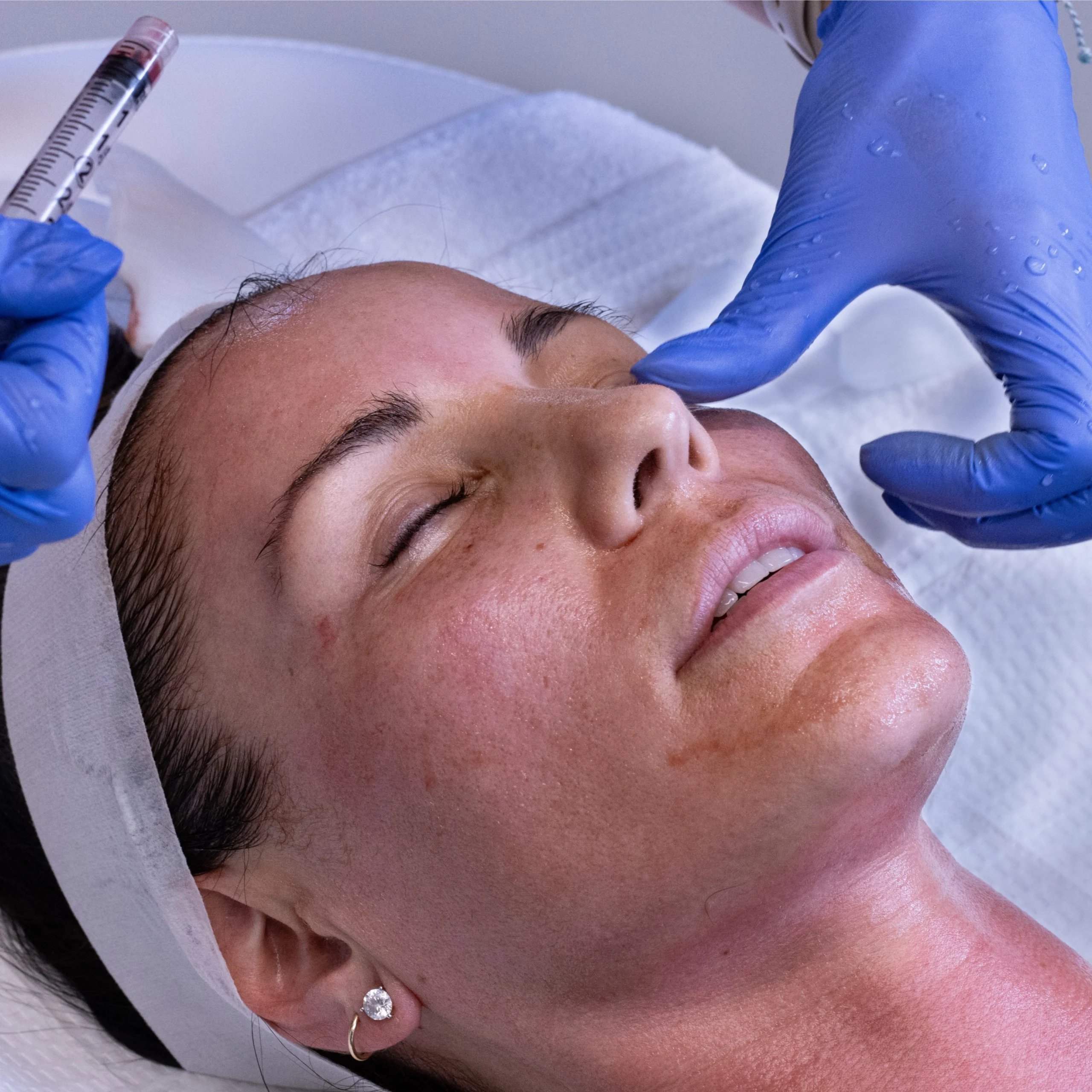 Microneedling and PRP in Fresno