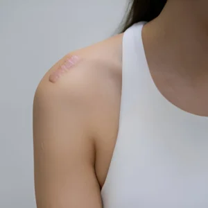 Scar and Keloid Treatment
