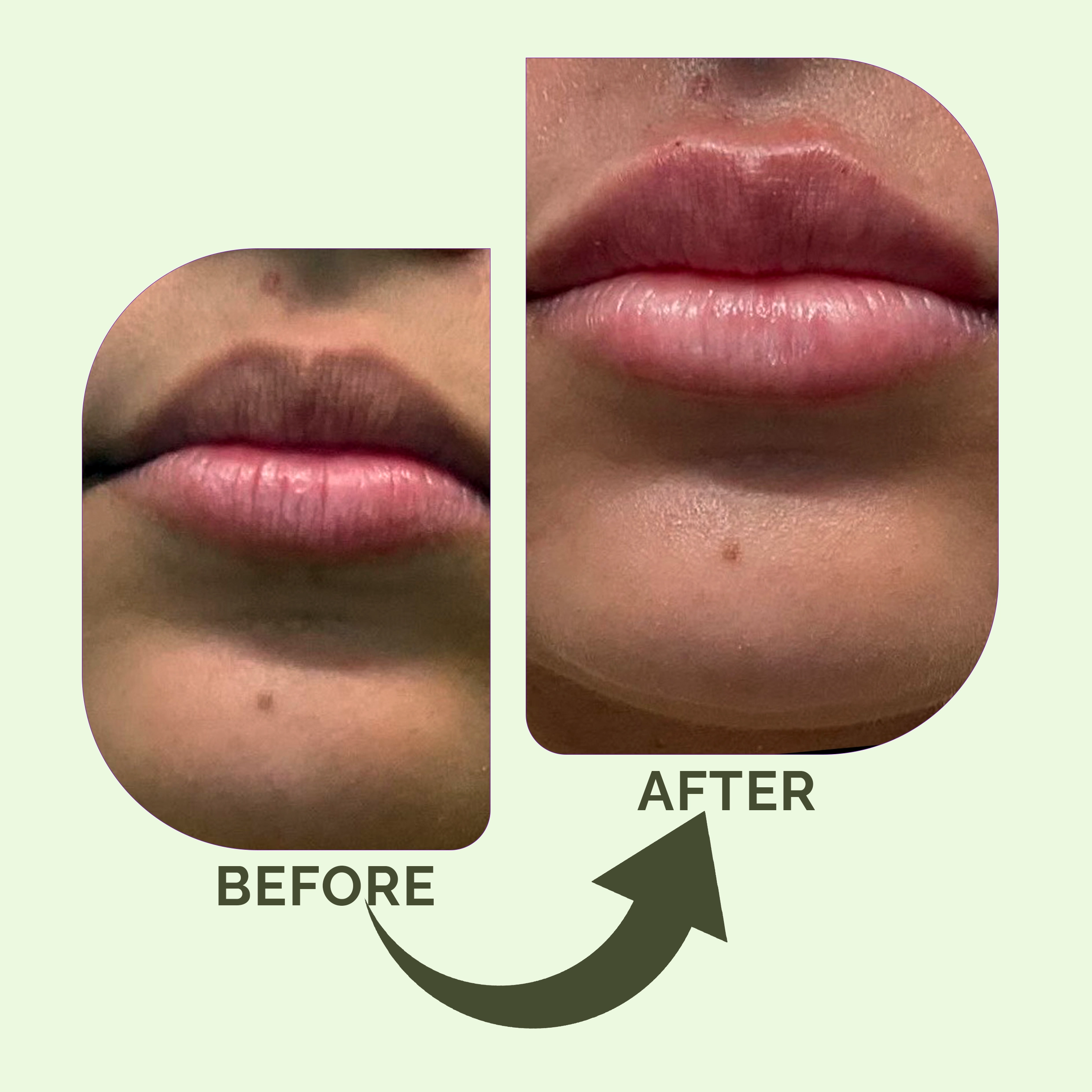 Dermal filler treatment at Cyrus Cosmetics Fresno