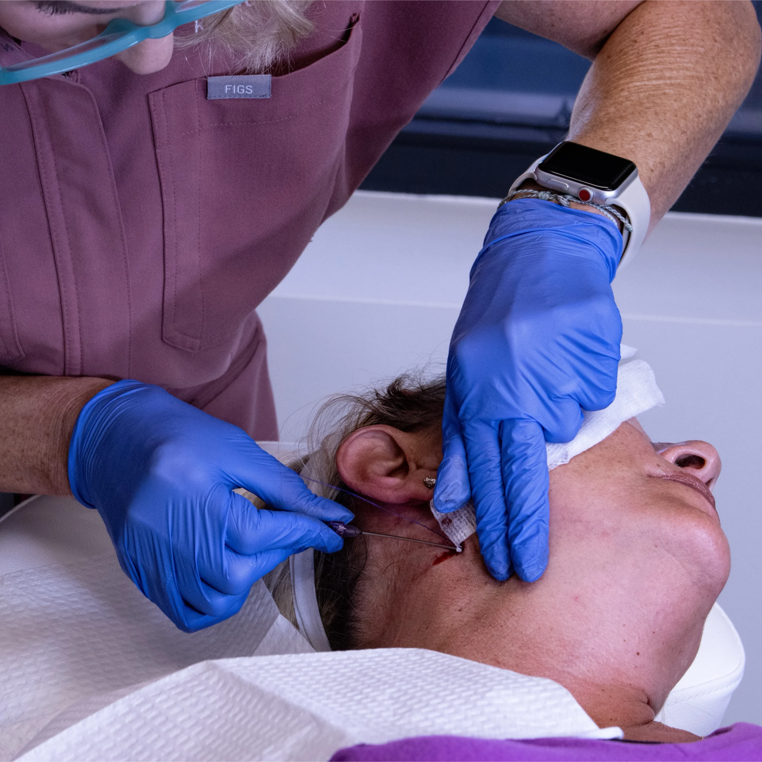 PDO thread lift procedure at Cyrus Cosmetics Fresno