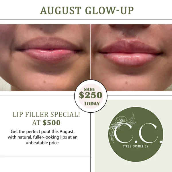 Lip Filler - Image 2