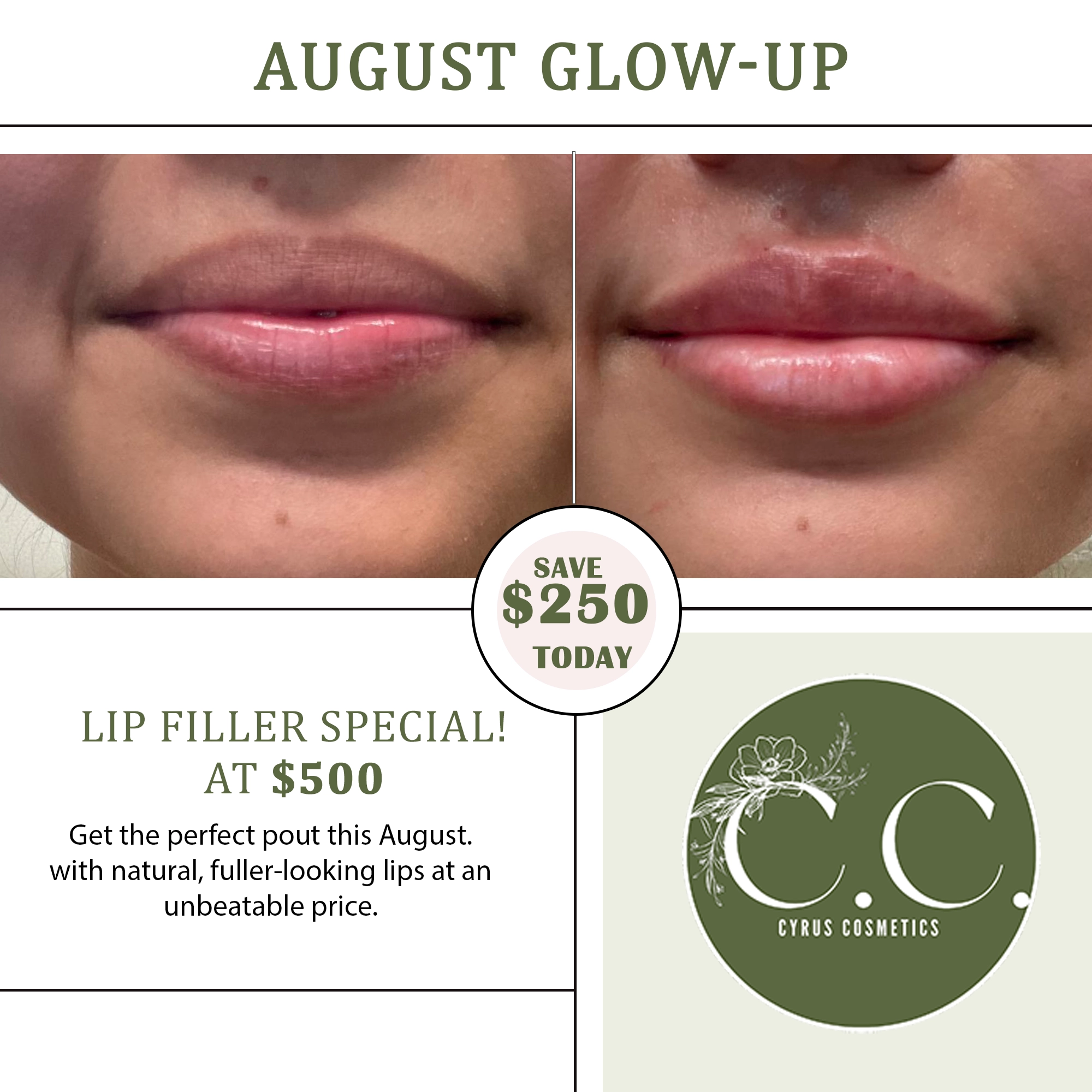 close-up-woman-getting-lip-filler copy