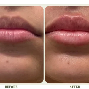 Lip Filler