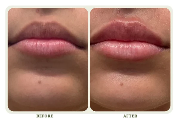 Lip Filler
