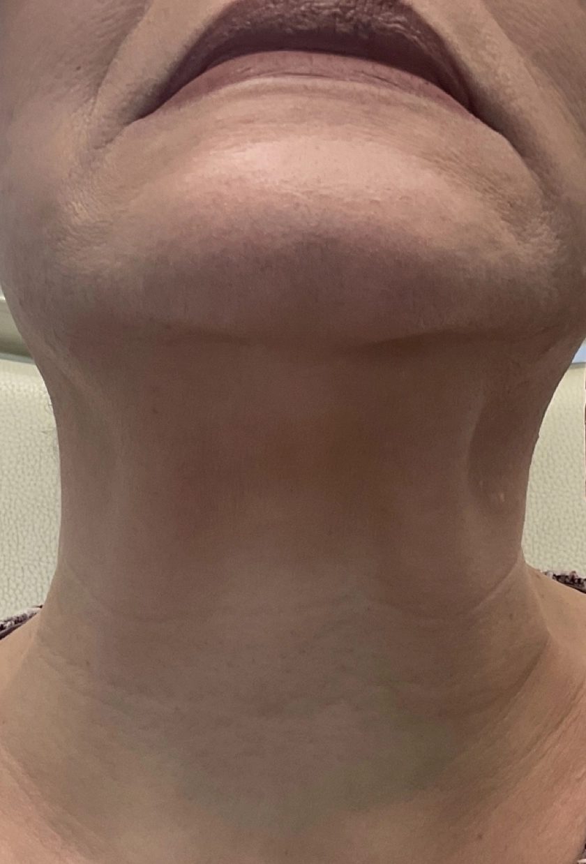 After Botox treatment - smoother, youthful skin