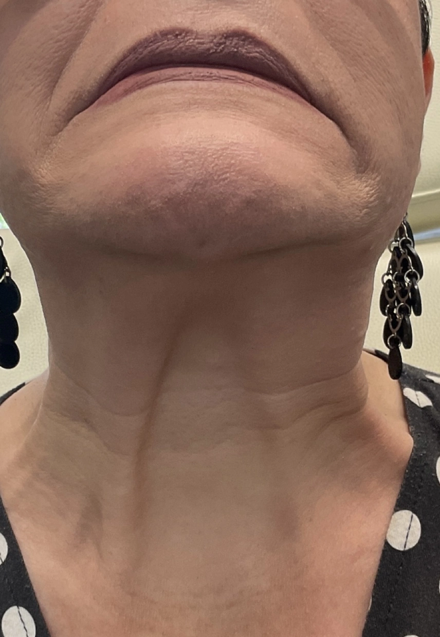 Before Botox treatment - visible lines
