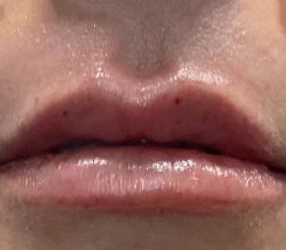 After Botox treatment - smooth forehead, reduced wrinkles, natural youthful appearance