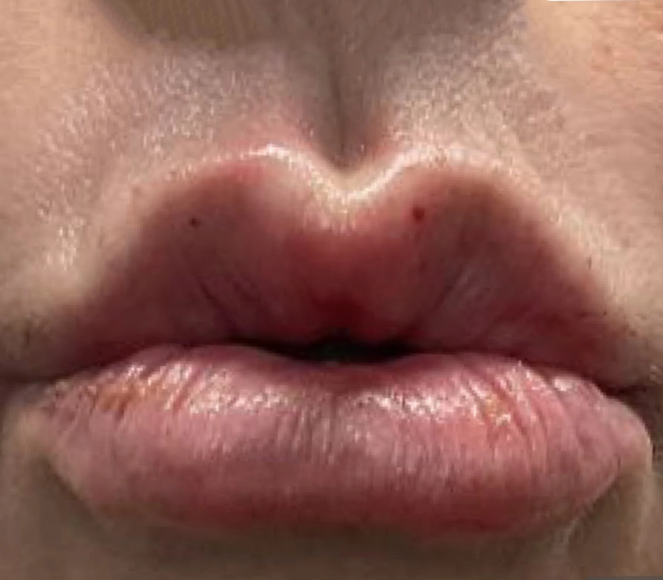 After Botox treatment - smooth forehead, reduced wrinkles, natural youthful appearance