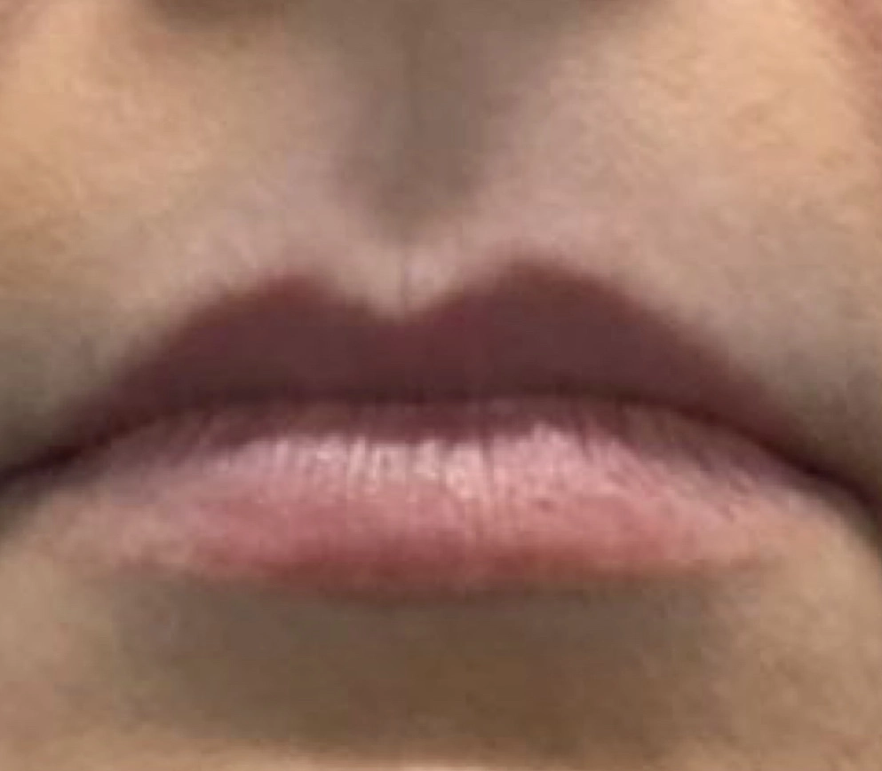 Before Botox treatment - visible forehead lines and frown lines