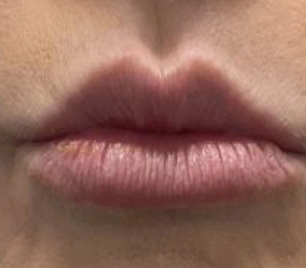 Before Botox treatment - visible forehead lines and frown lines