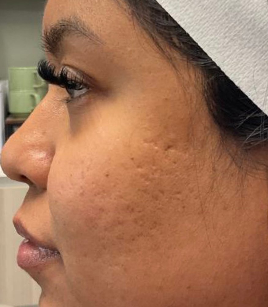 After microneedling treatment - smoother, more radiant skin