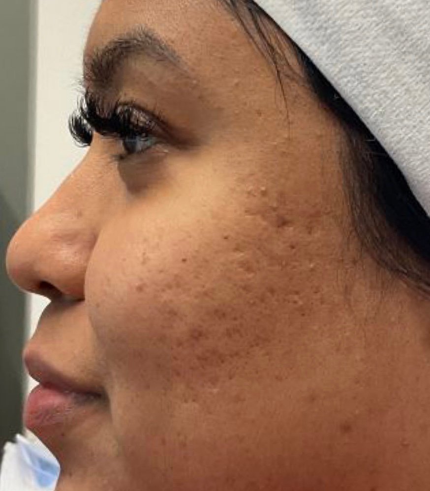 Before microneedling treatment - visible texture and tone irregularities