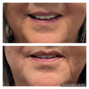 1 syringe of Filler in the Marionettes