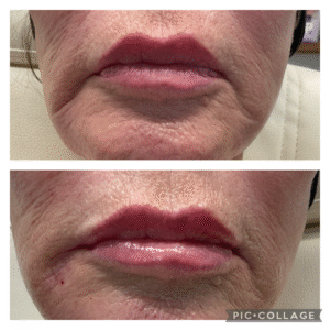 Lip filler and Marionette lines
