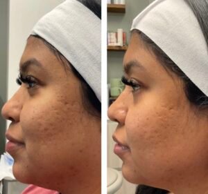Micro needling1