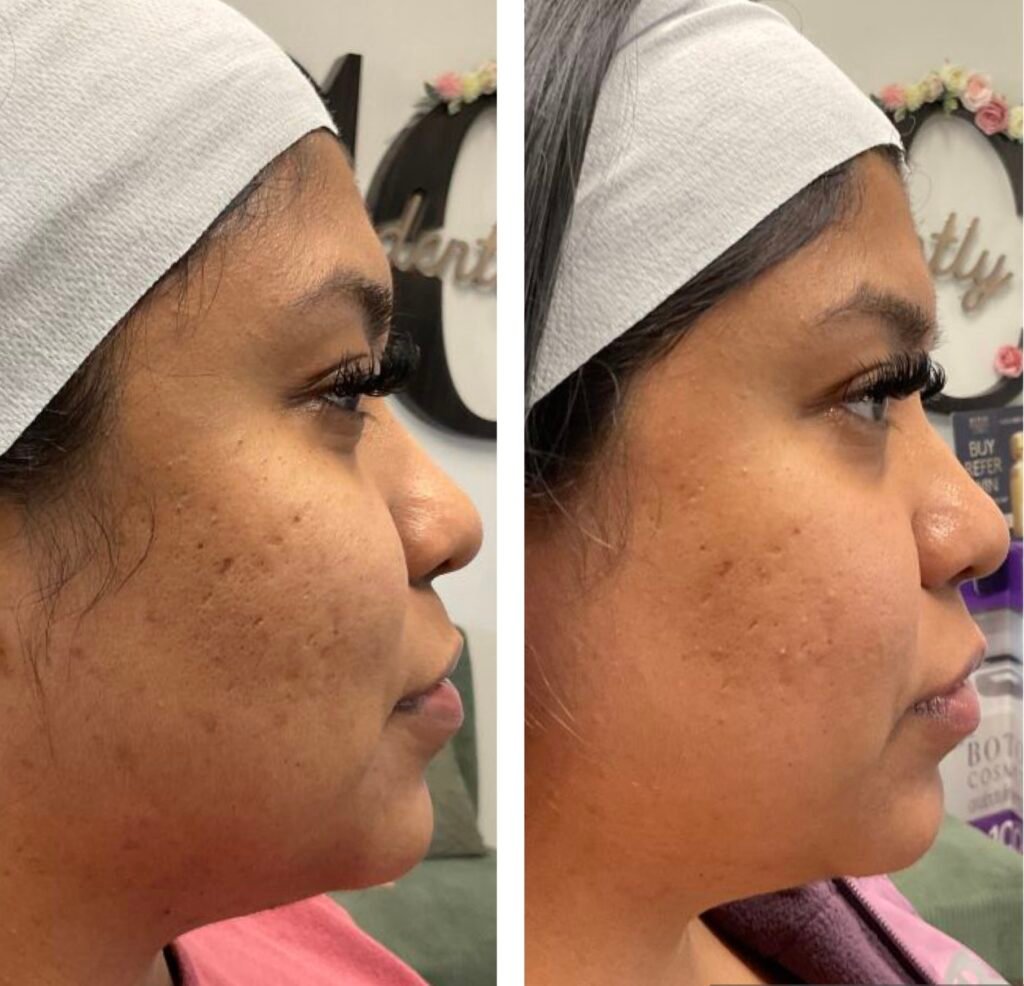 Microneedling + PRP at Cyrus Cosmetics