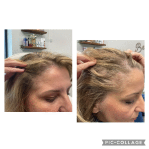 PRP for hair restoration. Please edit and block out eyes and face