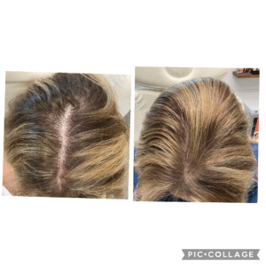 PRP on scalp