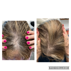 PRP on scalp. Block face