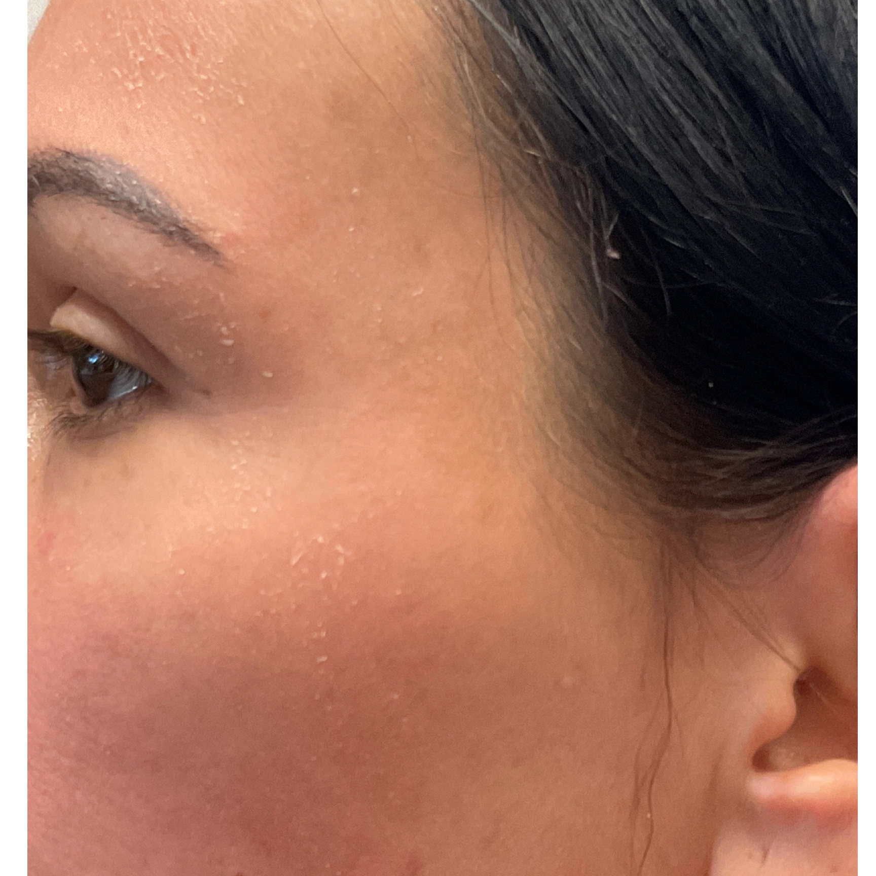 After Medical-Grade Peels in Fresno