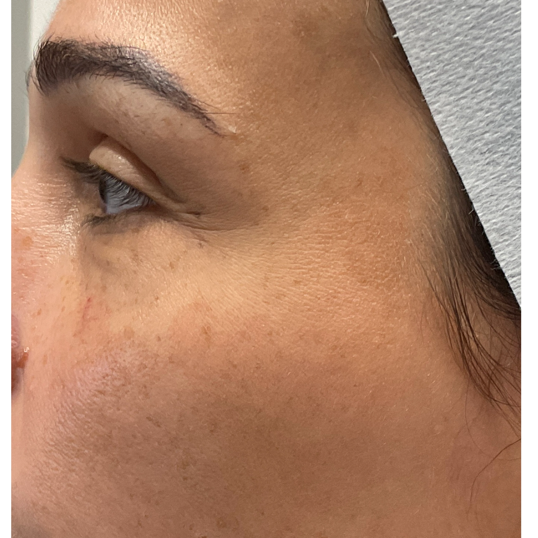 Before Medical-Grade Peels in Fresno