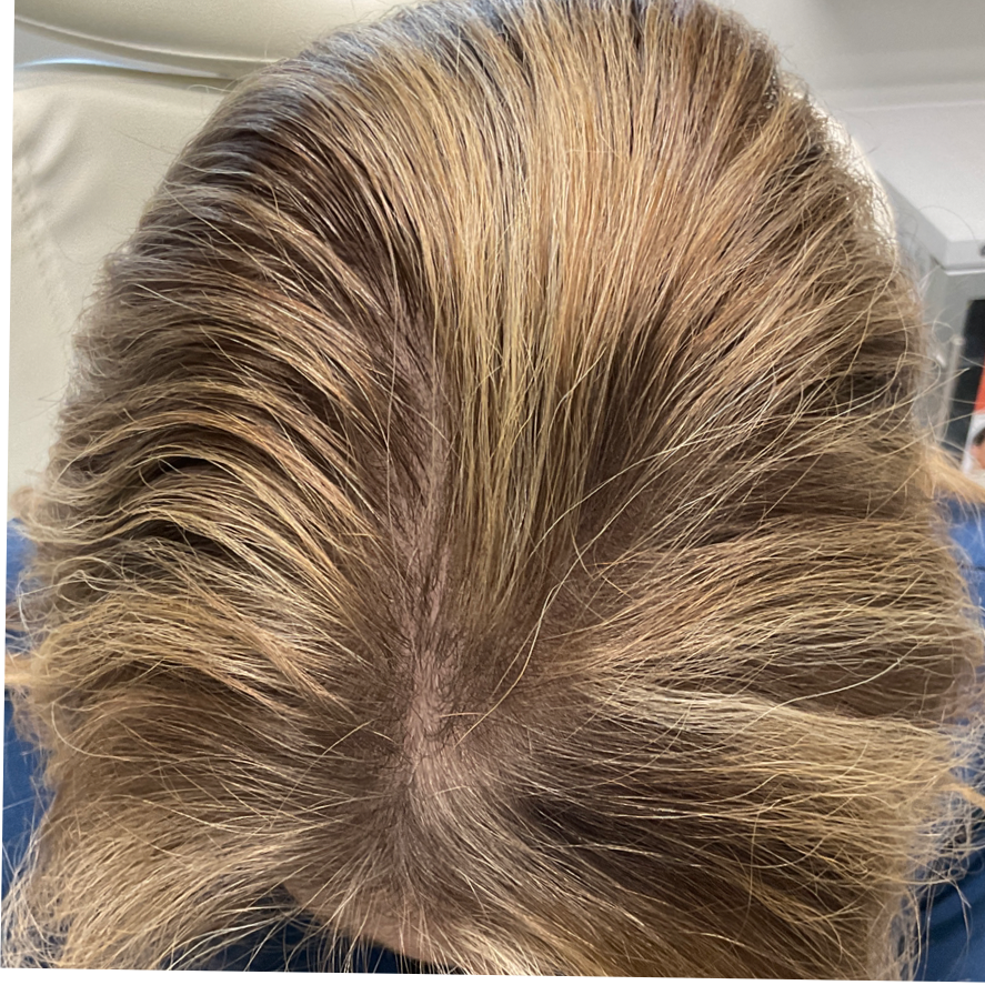 After Lip Fillers treatment image