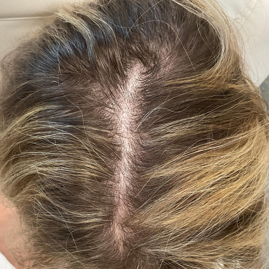 Before Lip Fillers treatment image