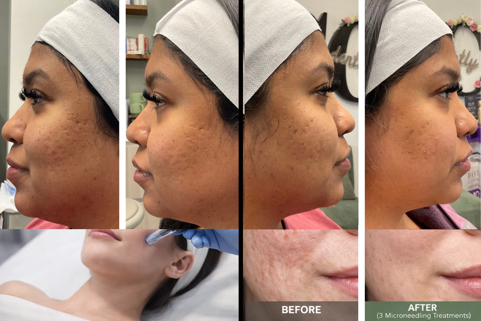 microneedling before and after improvement in acne scars texture and glow