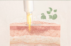 fractional laser technology microscopic treatment zones illustration