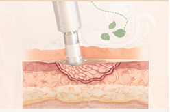 non-ablative laser resurfacing collagen stimulation illustration