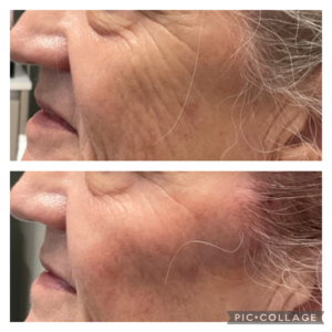 June Juvéderm Filler Special - Buy 1, Get 2nd Syringe 50% Off