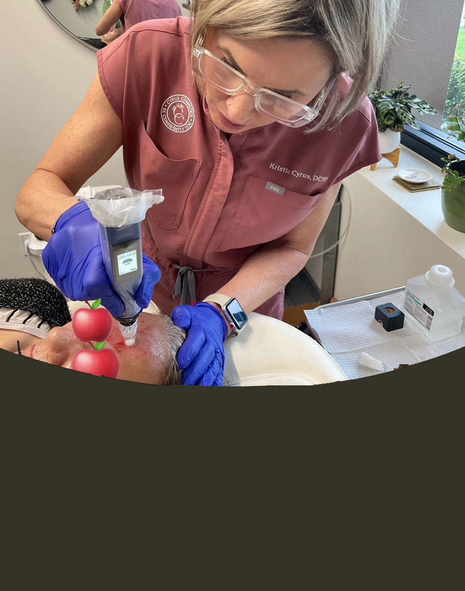 Microneedling October Special at Cyrus Cosmetics Fresno