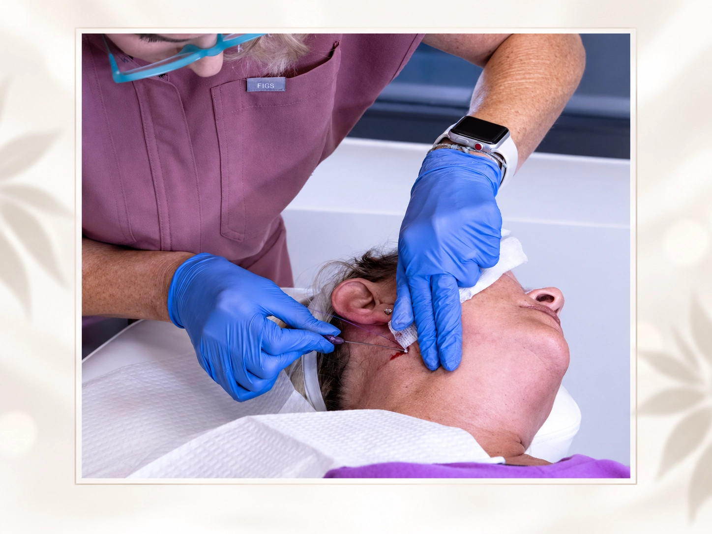 PDO thread lift treatment at Cyrus Cosmetics Fresno