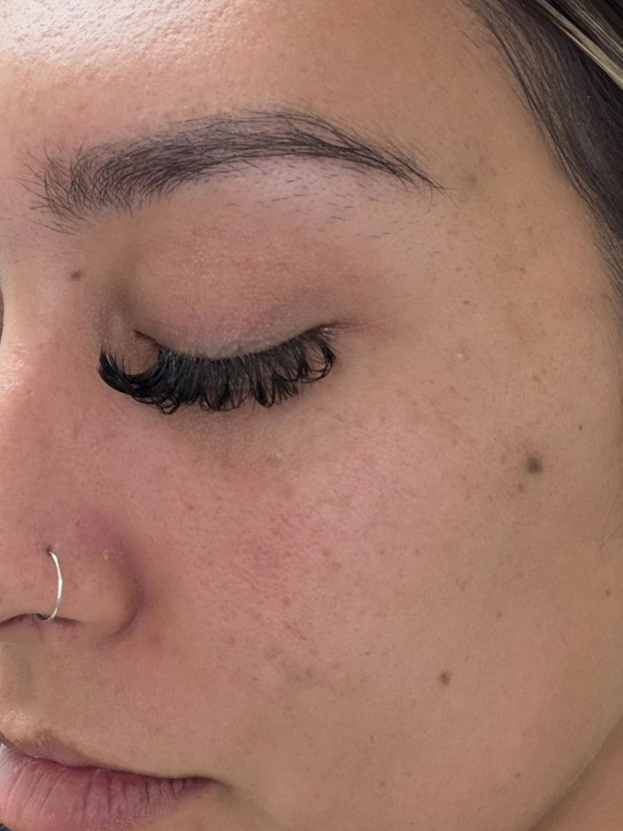 Skin after VI Peel treatment