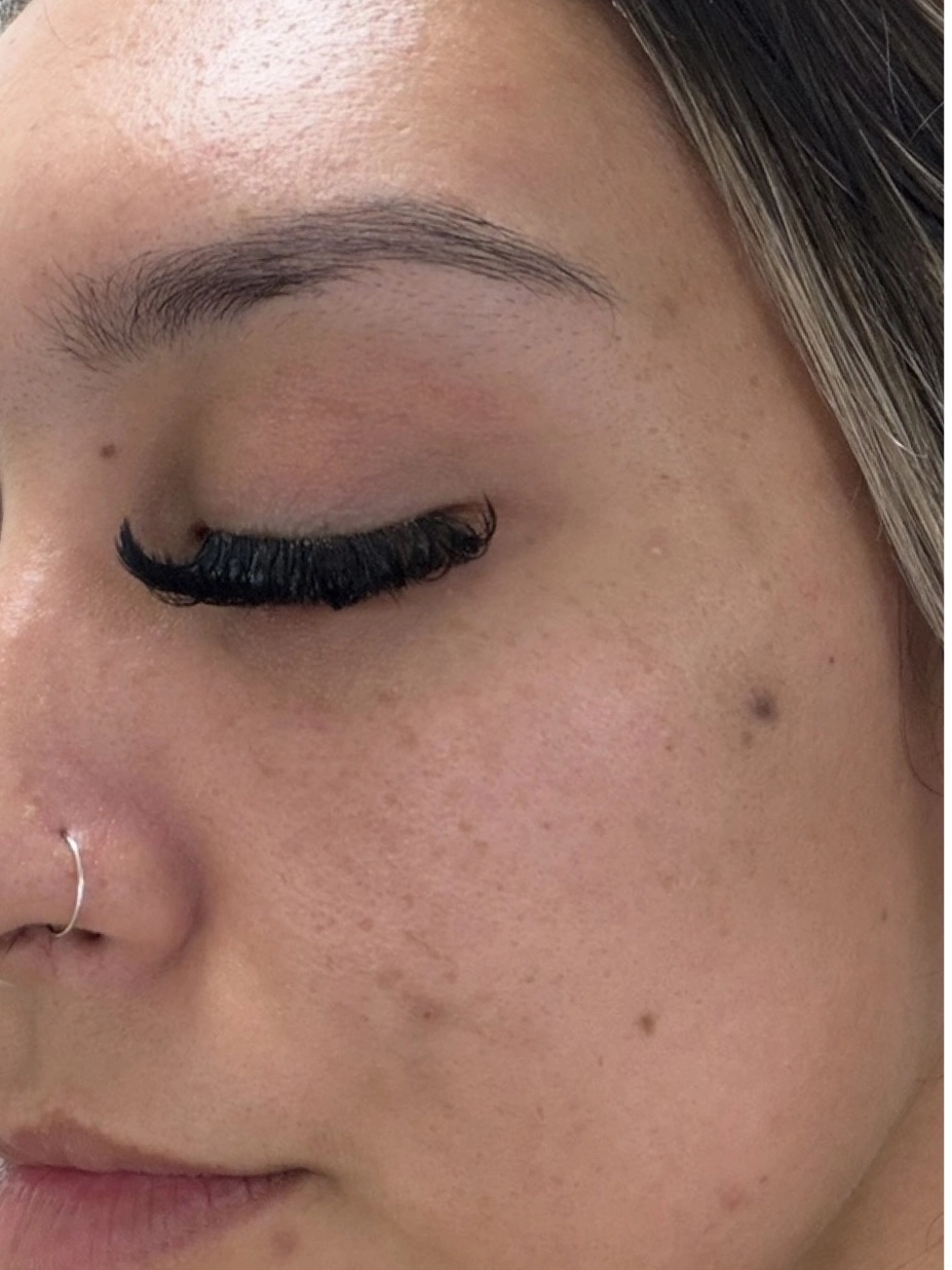 Skin before VI Peel treatment