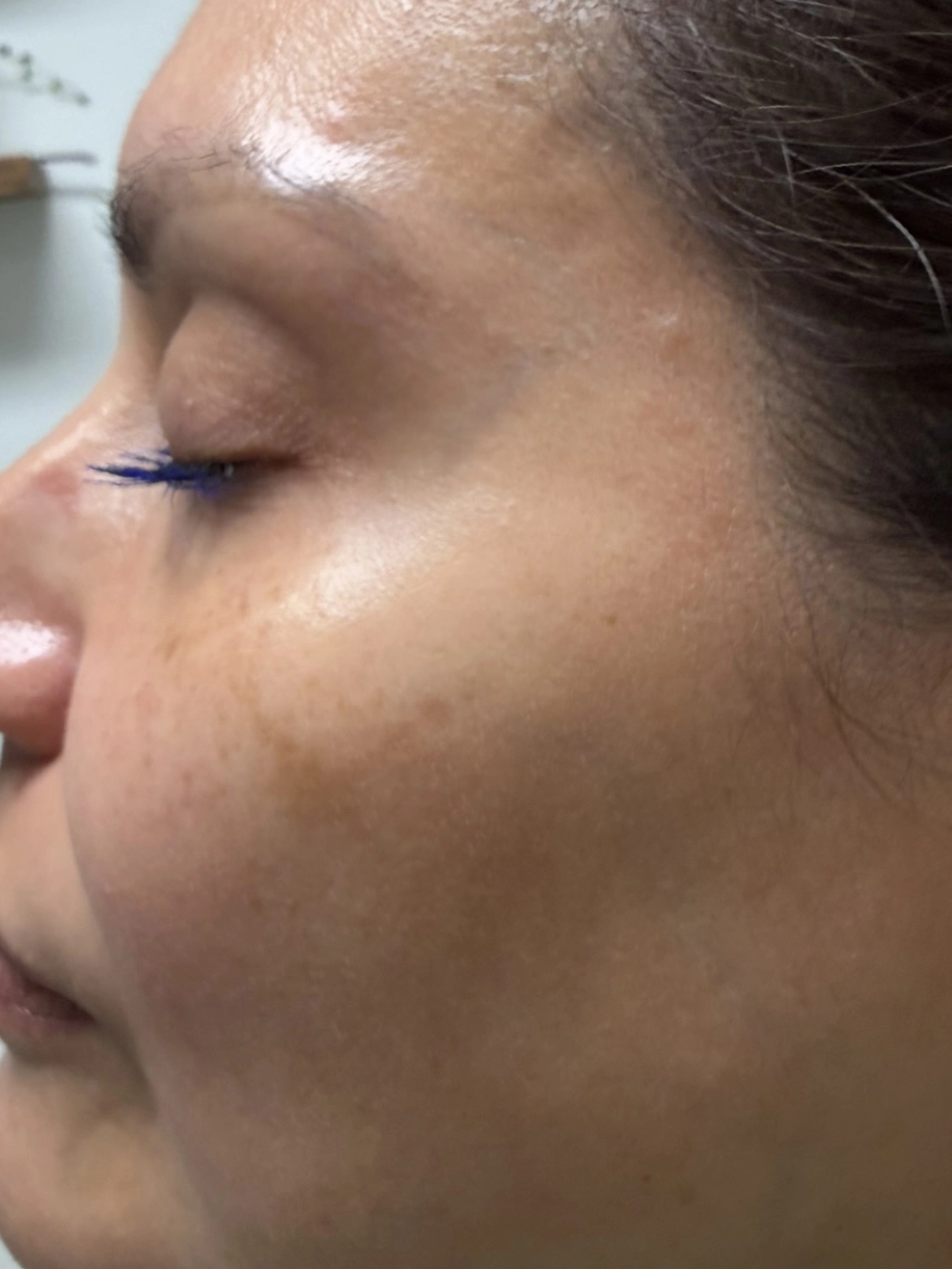 Skin after VI Peel treatment