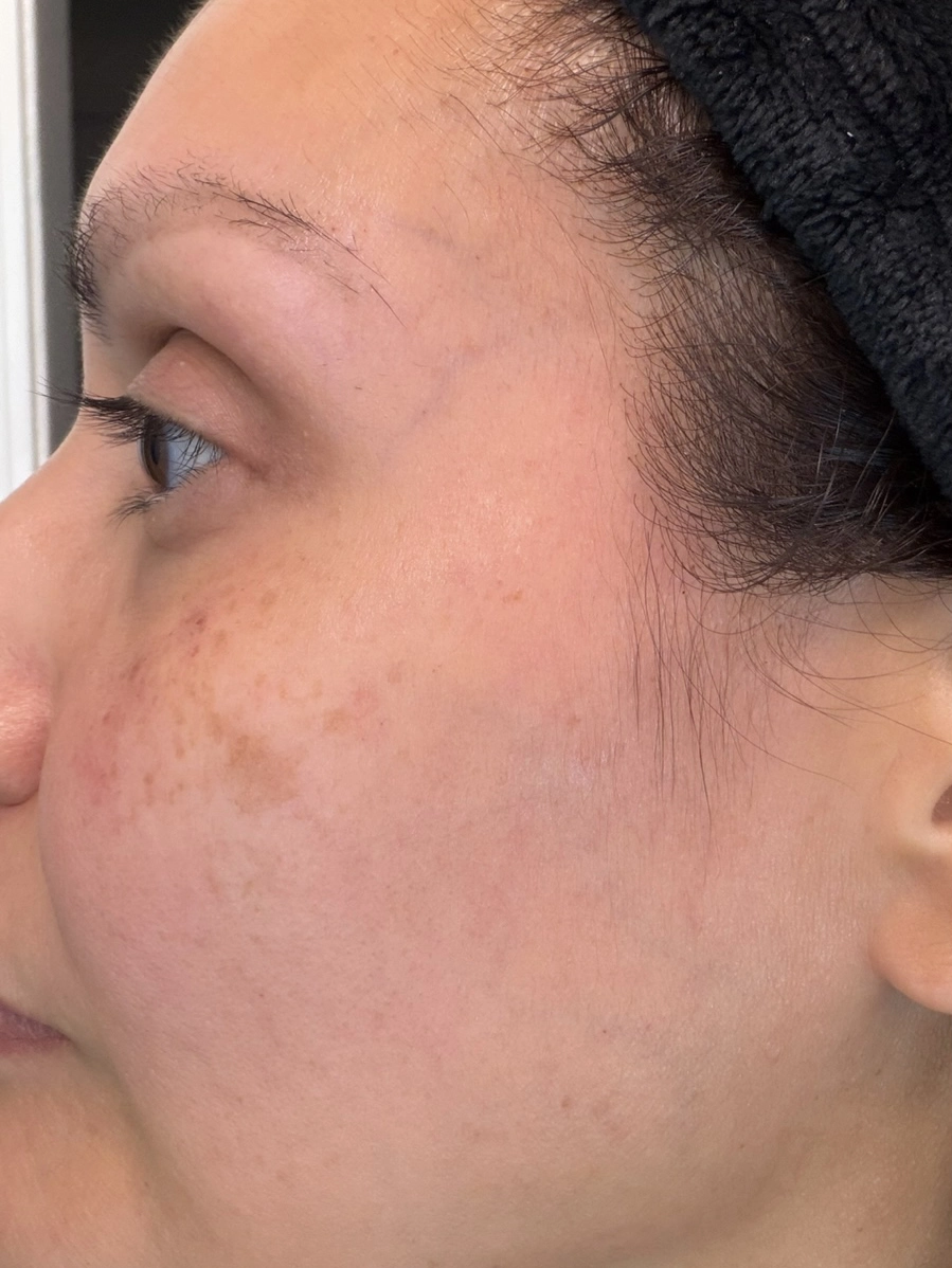 Skin before VI Peel treatment