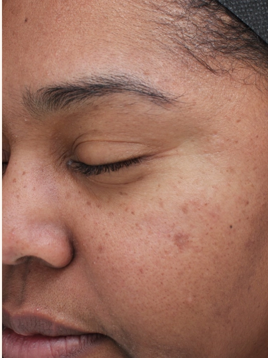 Skin after VI Peel Precision Plus and Peptides