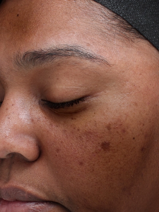 Skin before VI Peel Precision Plus and Peptides